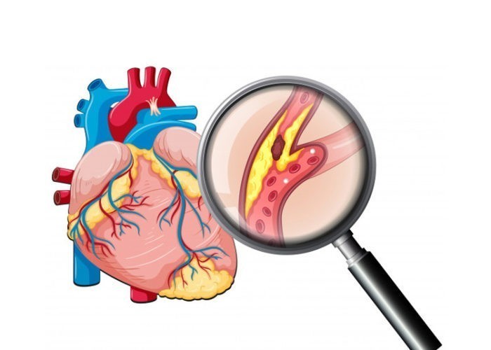 Coronary heart disease: Causes, symptoms & treatment | CHD Group